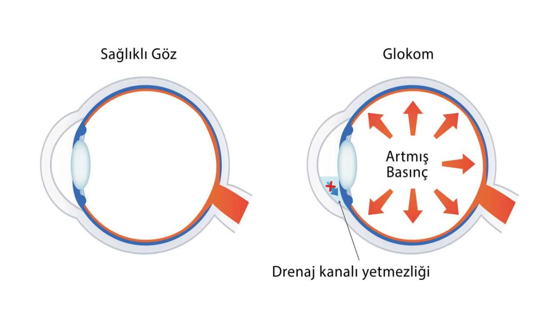 Göz Tansiyonu Belirtileri Ve Tedavisi