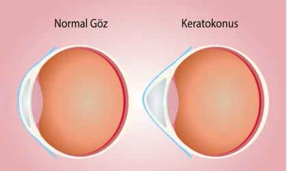 KERATOKONUS NEDİR? KERATOKONUS TEDAVİSİ NASIL YAPILIR?