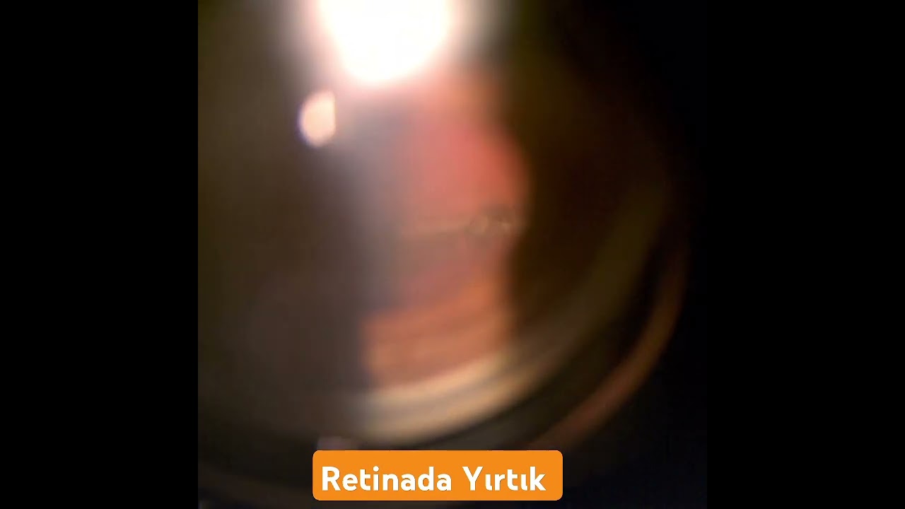 Retinada Yırtık #retinayırtık #retinadekolmanı